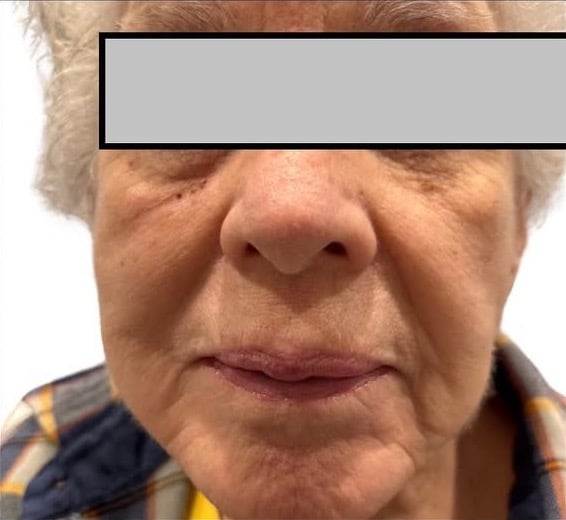 Before Image: Procell Microneedling - front