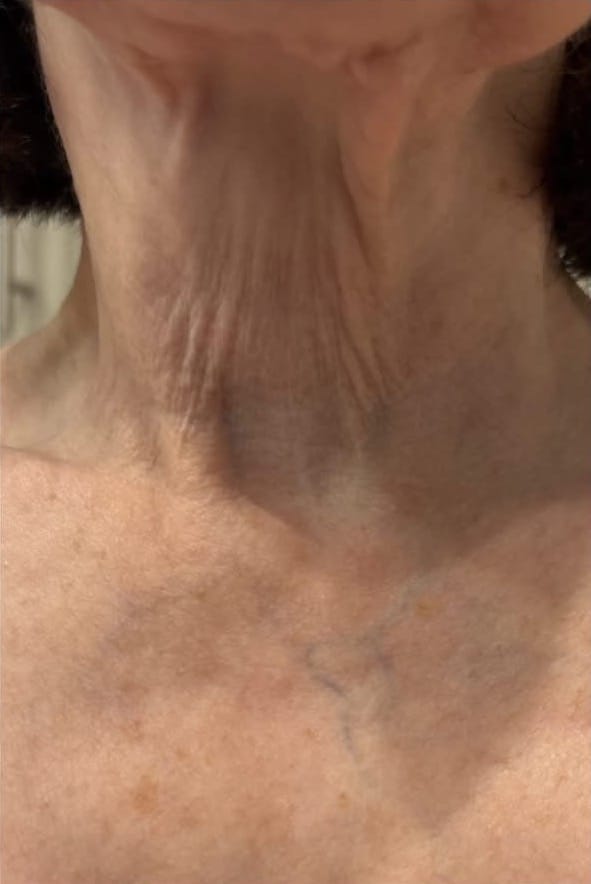 Before Image: Procell Microneedling - front